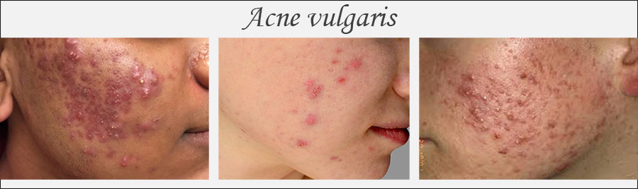 Acne vulgaris