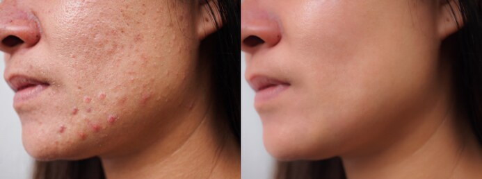 acne vulgaris progress