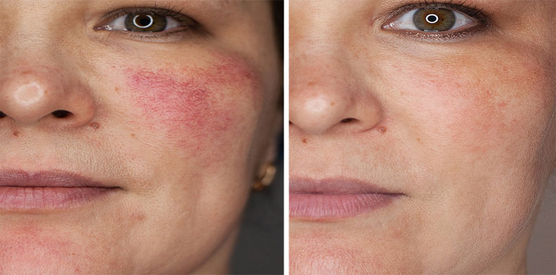 rosacea progress