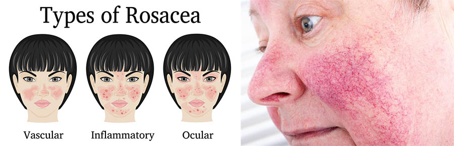 types of rosacea with example