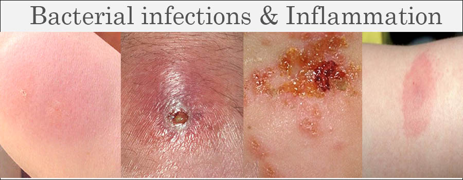 bacterial infection inflammation