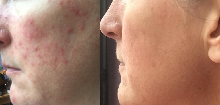 inflammation before after