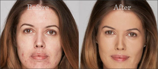 skin bacterial infection before after