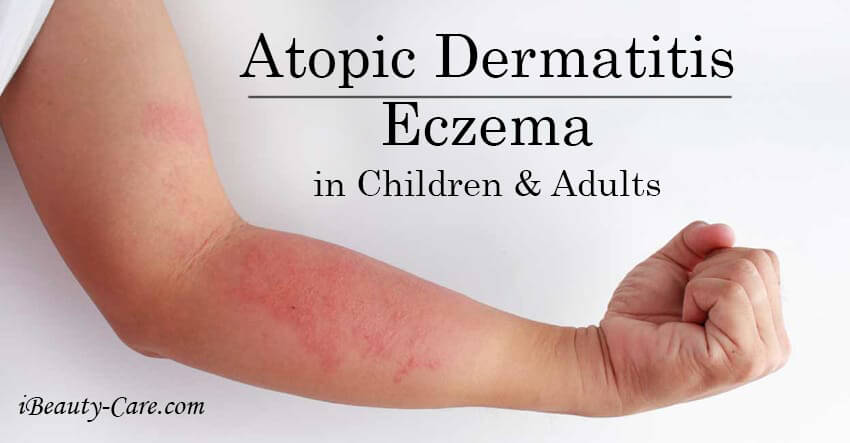 Atopic Dermatitis Eczema
