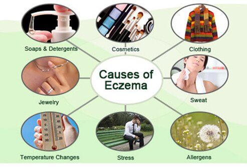 eczema atopic dermatitis causes