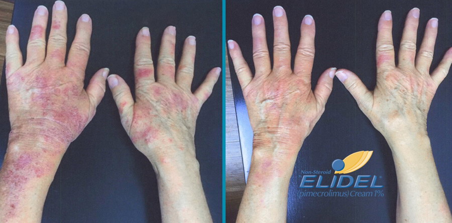 elidel exema bifore after