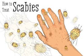 how to treat scabies
