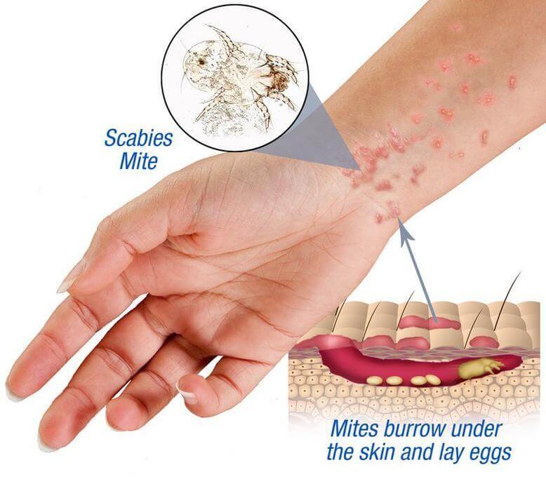 scabies mite