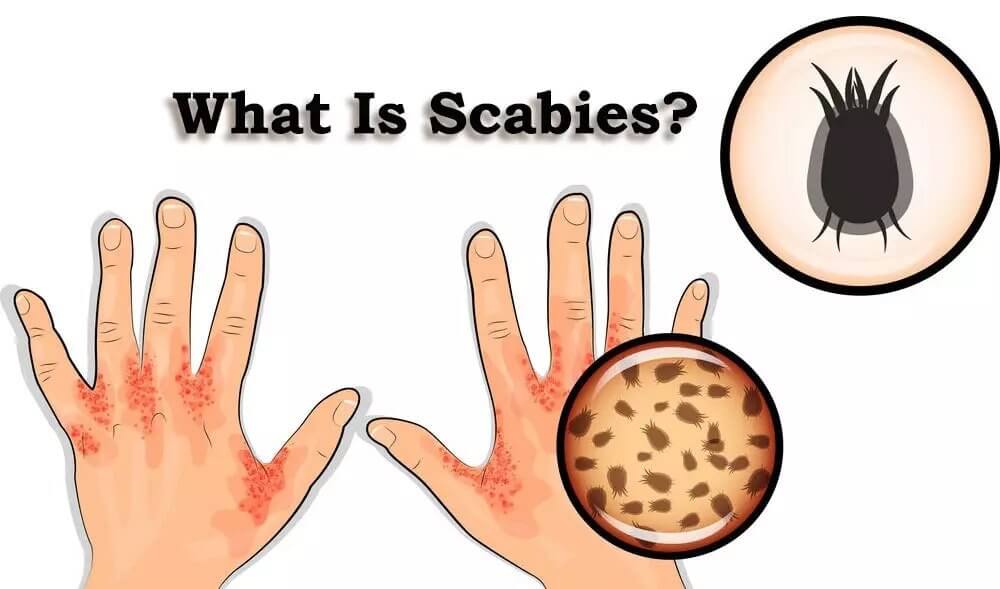 what is scabies mite