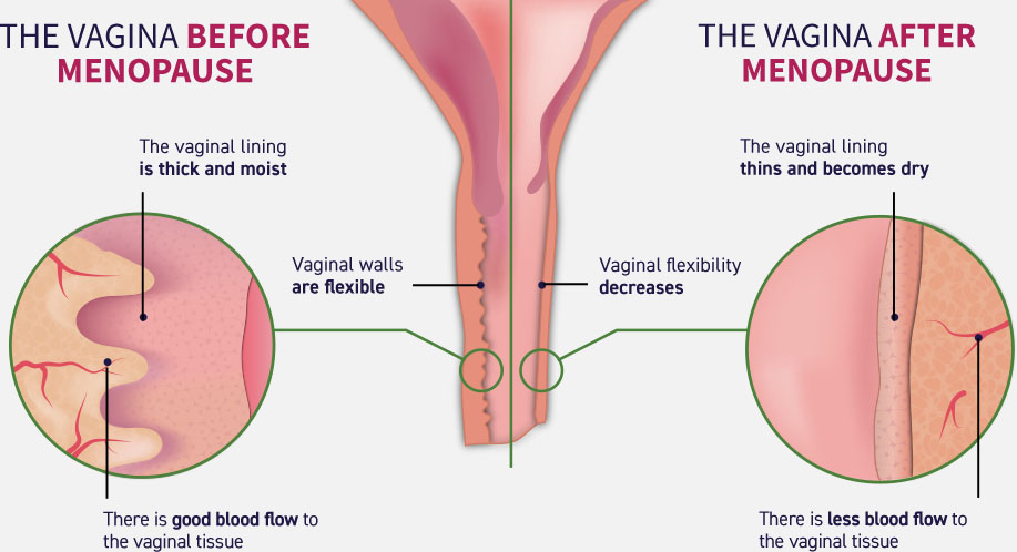 /vagina before after menopause infographic