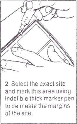 Prilox cream or Generic Emla application