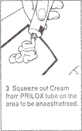Prilox cream or Generic Emla application