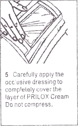 Prilox cream or Generic Emla application
