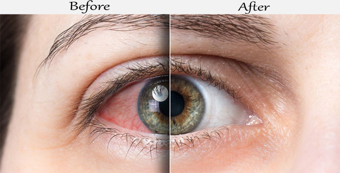 restasis before after