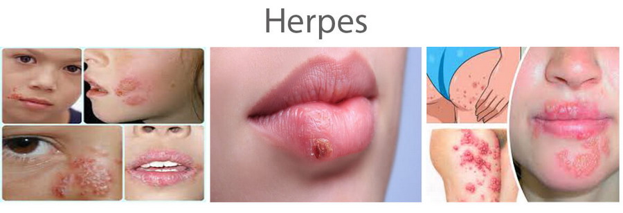 herpes problems