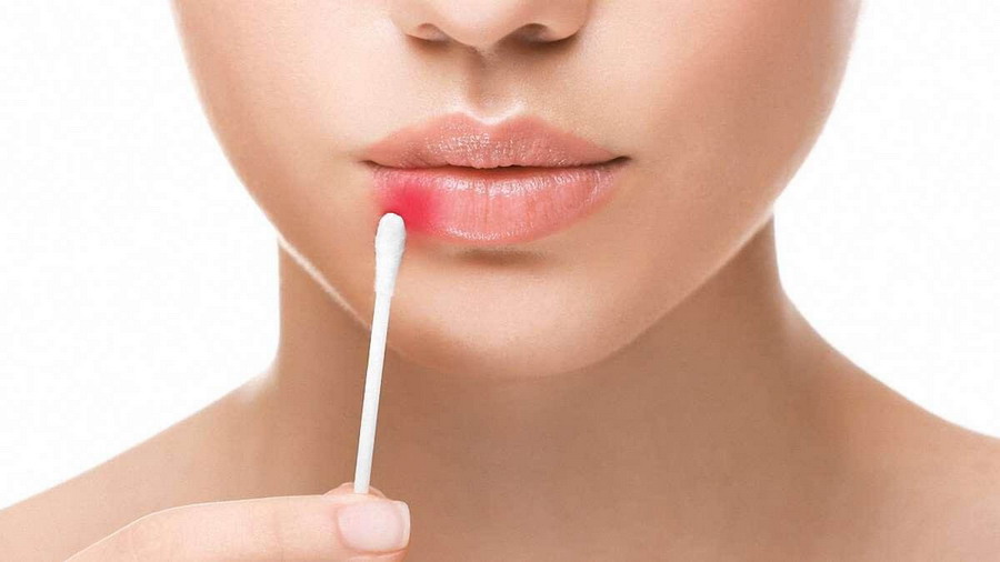 lips herpes cream application