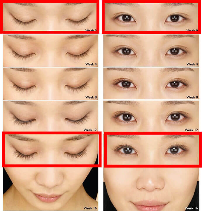 careprost before after