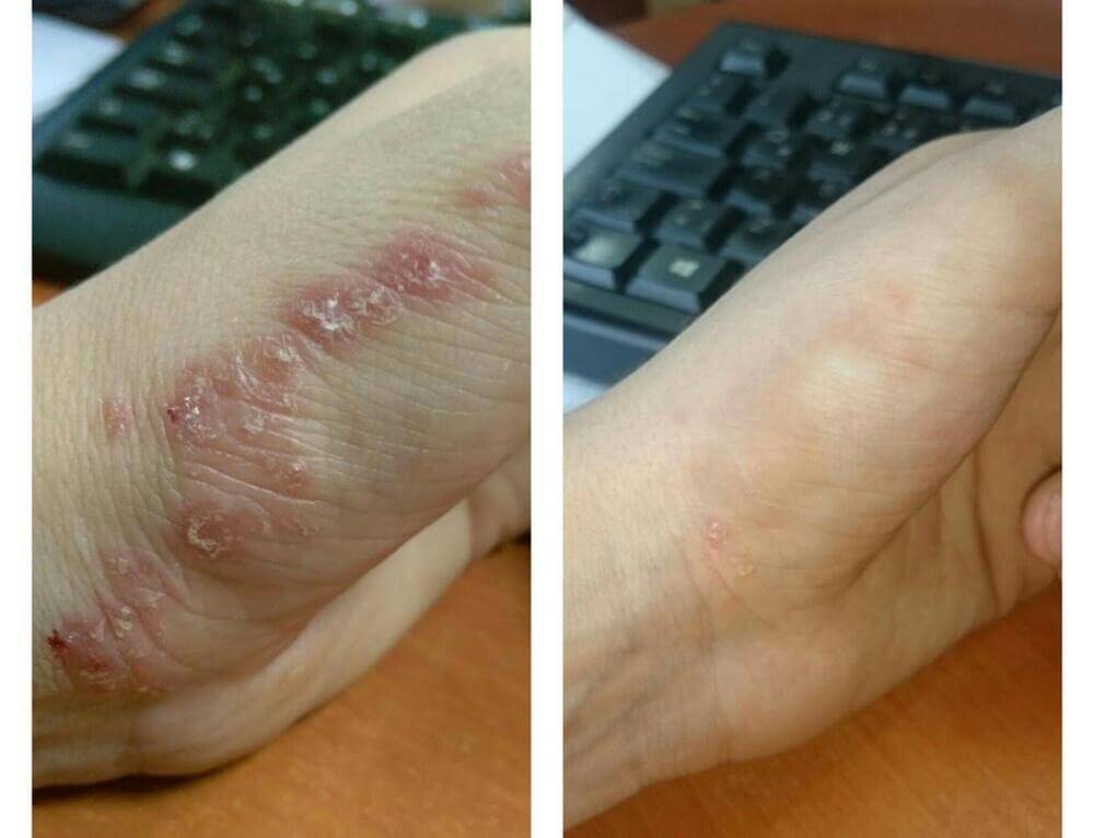 dermovate before after