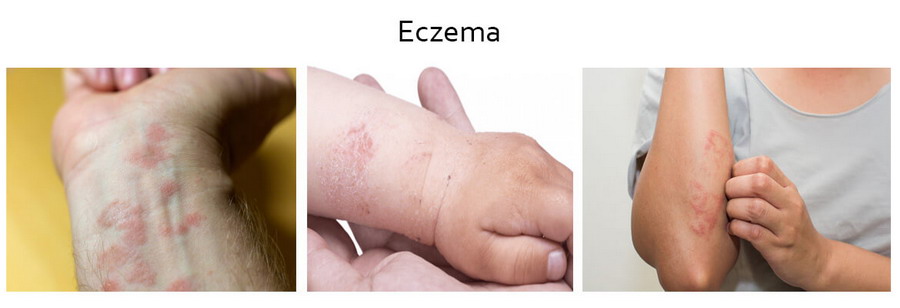 eczema