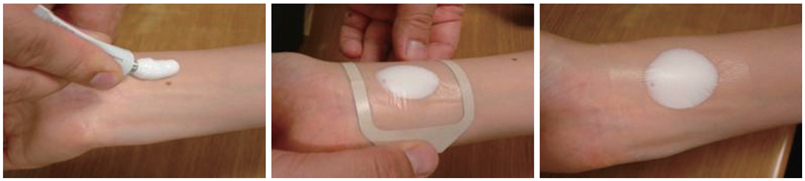 prilox cream application