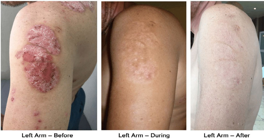 dermovate before after