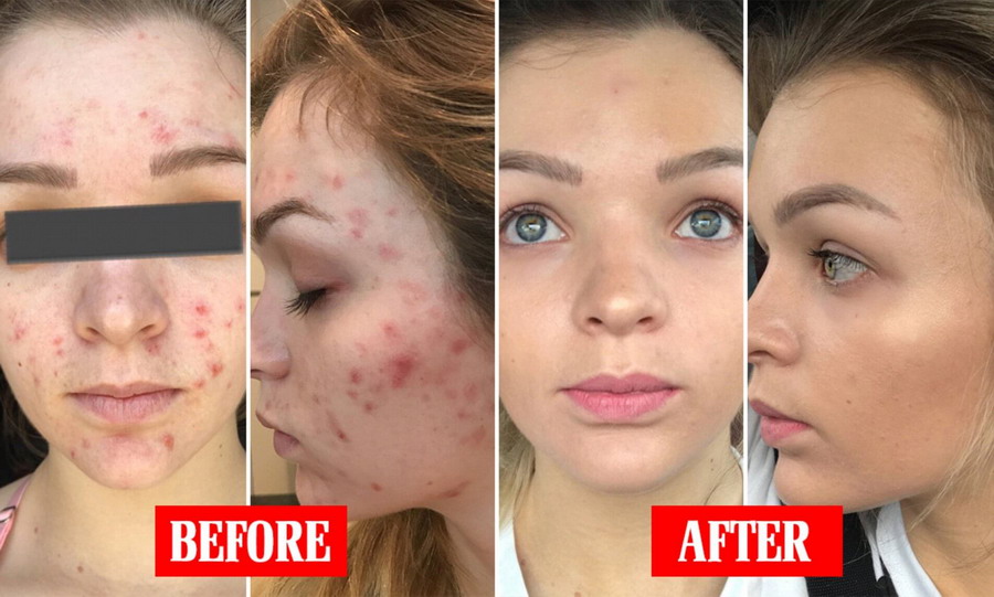 retin-a acne before after
