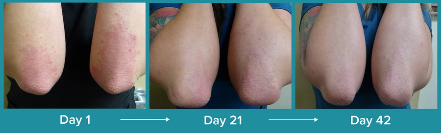 latisse generic weekly progress