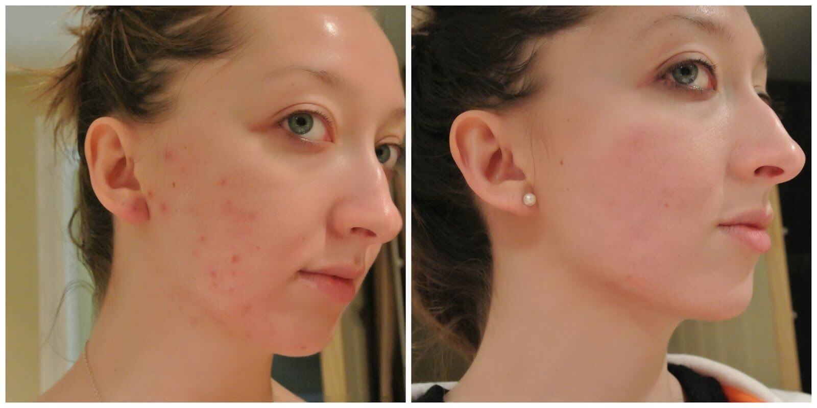 acne tazorac before after