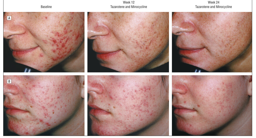 acne treatment with tazarotene