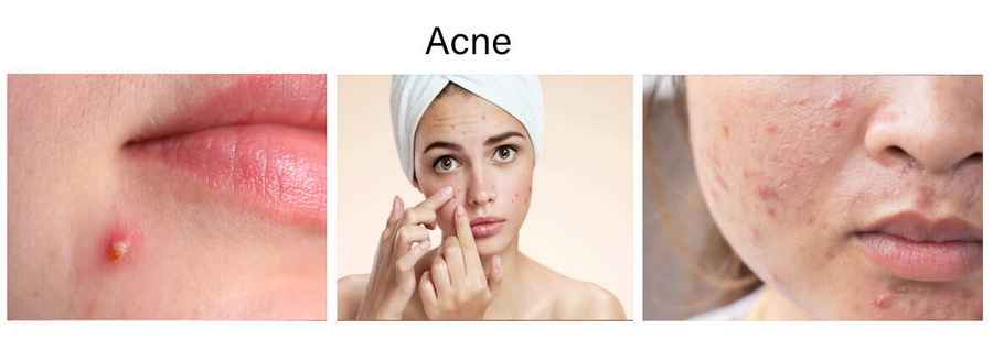 acne problems