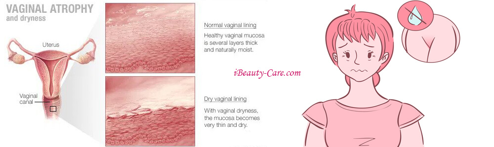 vagnal dryness
