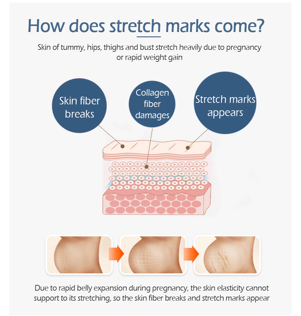 how does stretch marks come