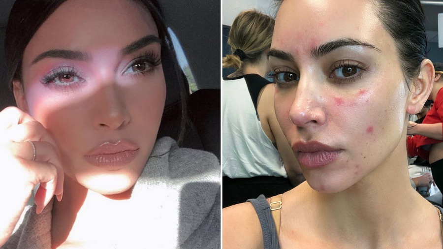 kim kardashian face psoriasis