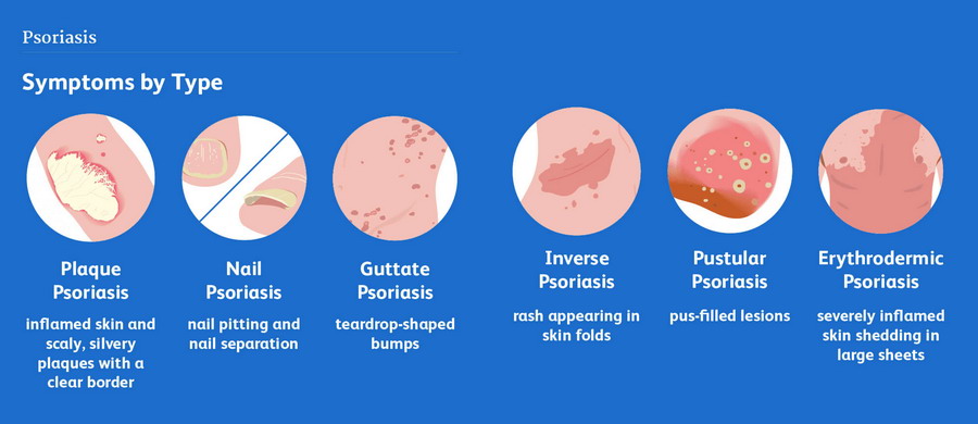 Psoriasis symptoms