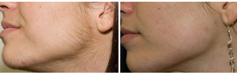 vaniqa before after